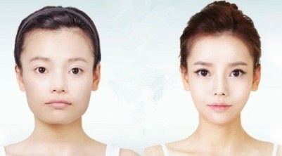 改臉型有后遺癥嗎