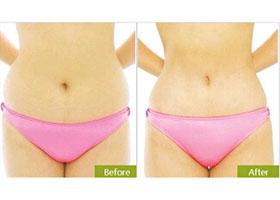 形體雕塑適應癥