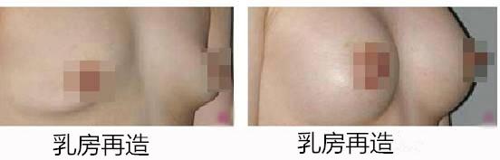 乳房再造術(shù)后注意事項(xiàng)