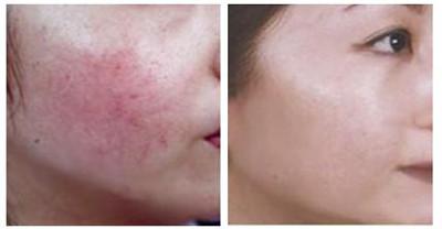 光子去紅血絲對(duì)比照