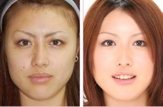 激光祛黑色素注意事項