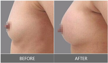 自體脂肪隆胸手術價格