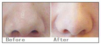 鼻翼縮小方式
