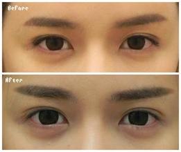 臥蠶整形術(shù)前后注意事項(xiàng)