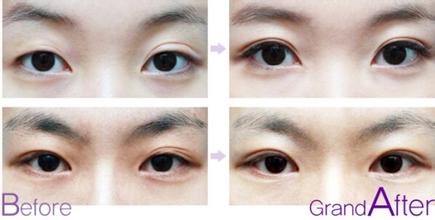 雙眼皮修復(fù)手術(shù)原則