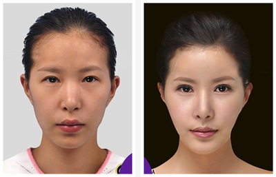 彩光嫩膚效果如何