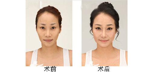 玻尿酸隆鼻是否有后遺癥