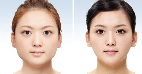 下頜角恢復(fù)時(shí)間多久