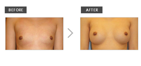 乳房再造最佳時機(jī)