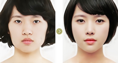 玻尿酸豐太陽穴能維持多久