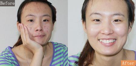 激光祛痘禁忌癥