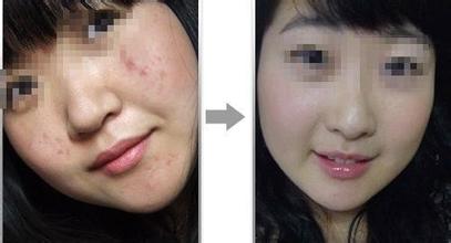 激光祛痘影響價格因素