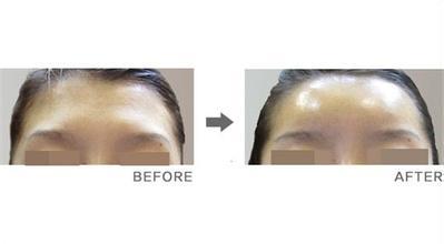 額部整形有哪些手術(shù)方法