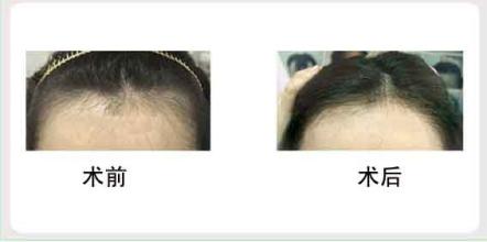 額部整形術(shù)后術(shù)后注意事項(xiàng)