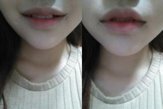 嘴角上揚(yáng)手術(shù)副作用