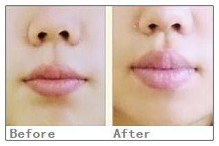 自體脂肪豐唇有哪些并發(fā)癥