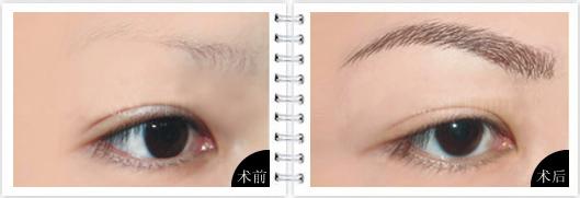 眉毛種植手術(shù)注意事項