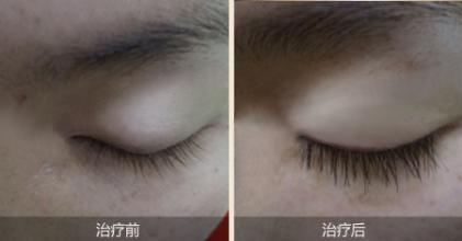 睫毛種植價格因素