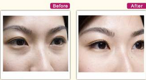 激光去黑眼圈價(jià)格是多少