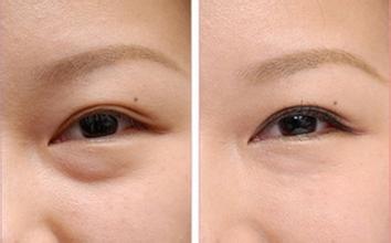 臥蠶整形術(shù)后護(hù)理