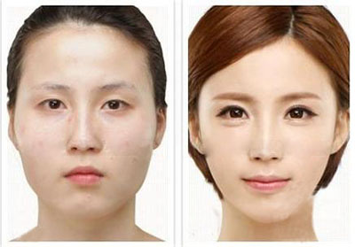 上瞼松弛整形對比照