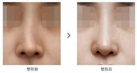 隆鼻失敗修復(fù)術(shù)后護理
