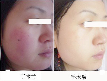 激光祛紅血絲注意事項