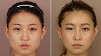 自體脂肪豐下巴對(duì)比照