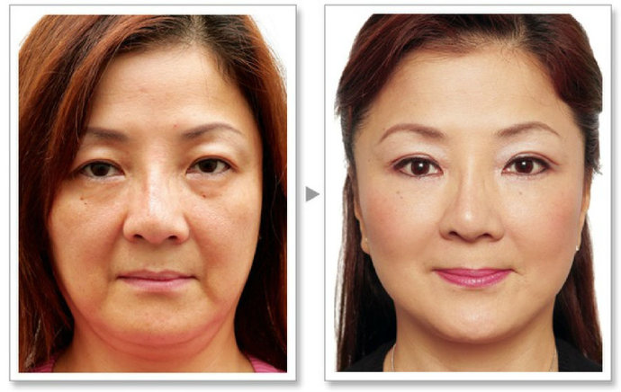 肉毒桿菌注射有哪些注意事項(xiàng)