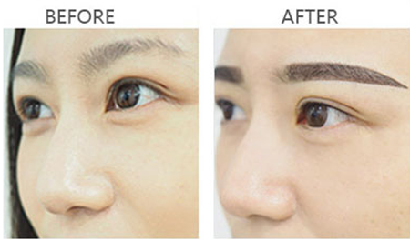 紋眉手術(shù)有哪些效果