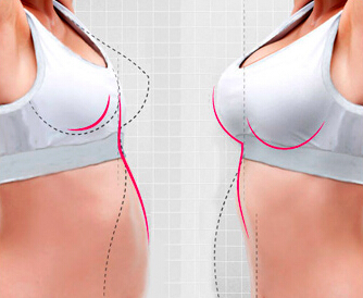 自體脂肪隆胸有哪些注意事項