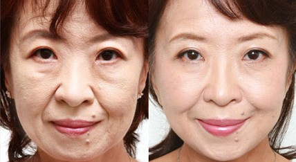 電波拉皮適應(yīng)人群有哪些