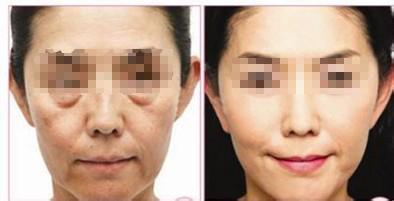 電波拉皮注意事項(xiàng)