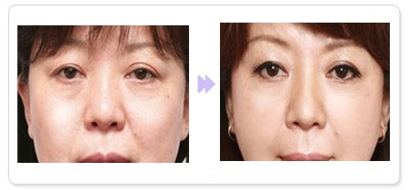 激光除皺治療效果如何