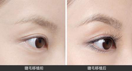睫毛種植有哪些術(shù)后護(hù)理