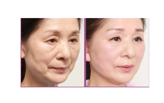 激光除皺功效與特點(diǎn)