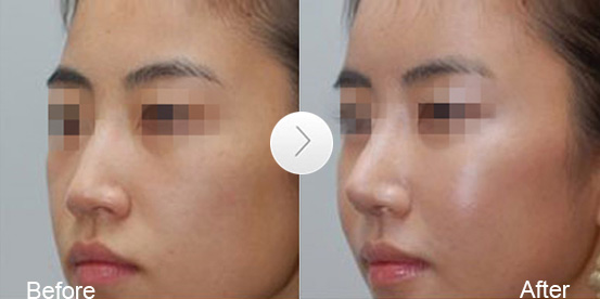 鼻尖矯正手術(shù)方法有哪些