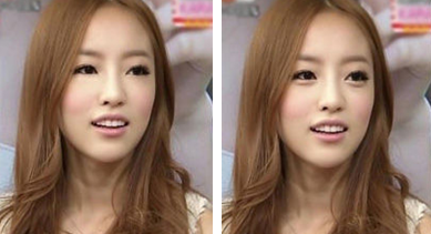 臥蠶手術(shù)有哪些適用人群