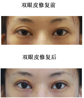 修復(fù)雙眼皮對比照