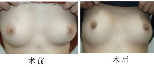 乳頭內(nèi)陷整形有哪些危害