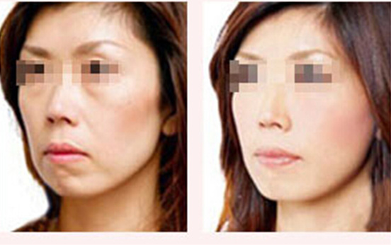 額部填充術(shù)適應(yīng)癥