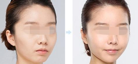 韓式改臉型對比照