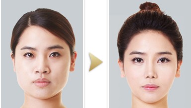 　下頜角整形對比照