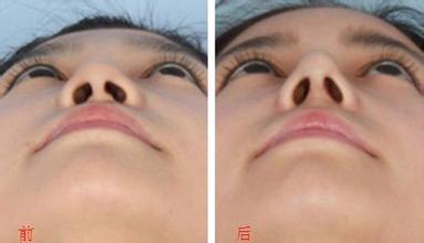 鼻翼縮小術(shù)有哪些優(yōu)勢