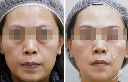 熱瑪吉緊膚除皺有什么效果