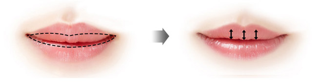 如何預(yù)防厚唇修薄術(shù)后風(fēng)險(xiǎn)