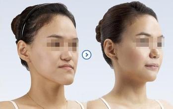 地包天矯正有哪幾種類(lèi)型