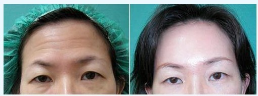 電波拉皮除皺優(yōu)勢(shì)有哪些