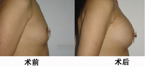 乳頭縮小對(duì)比照