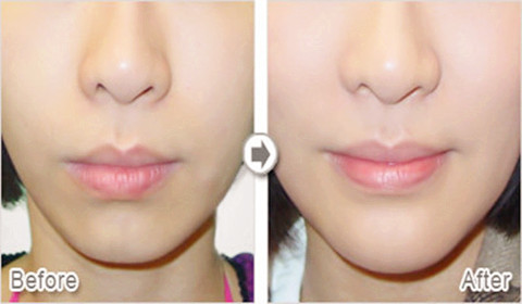 厚唇變薄術(shù)有什么優(yōu)勢